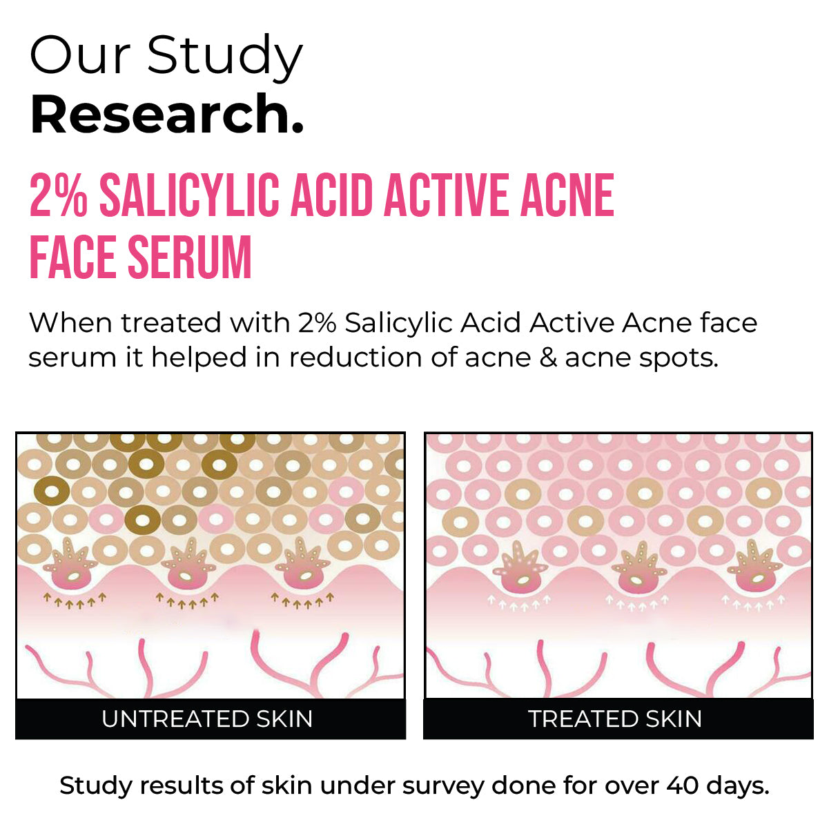 2% Salicylic Acid Active Acne Face Serum