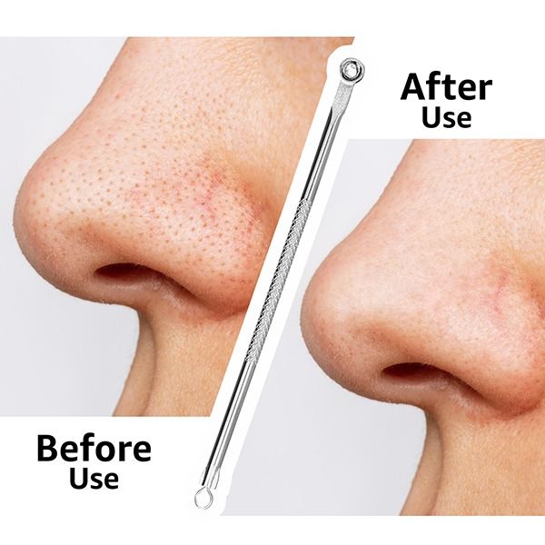 Blackhead Remover - Rounded - BHR-02